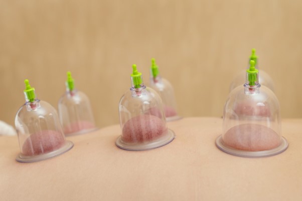 cupping Therapy